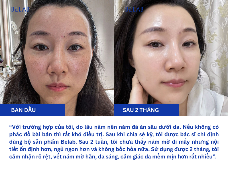 Doanh Nhân U40 Trị Nám Da Không Khó Nhờ Chọn Đúng Phương Pháp 2 Bai web 2