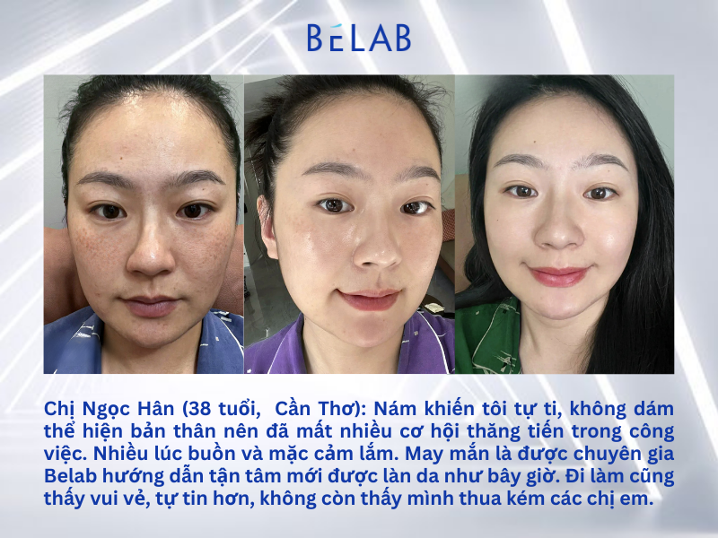 Mẹ Bỉm 38 Tuổi Trị Nám Sau Sinh Hiệu Quả Với Belab Cosmetic: Hành Trình Tái Sinh Làn Da Tươi Trẻ 2 Bai web 5